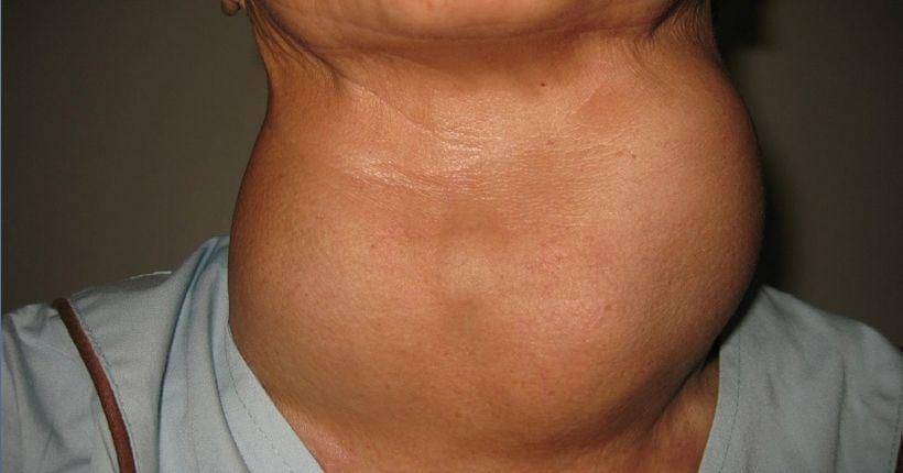 Thyroidnosurgery.com